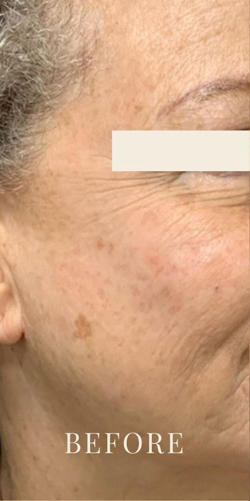 IPL Before & After Gallery - Patient 112346 - Image 1