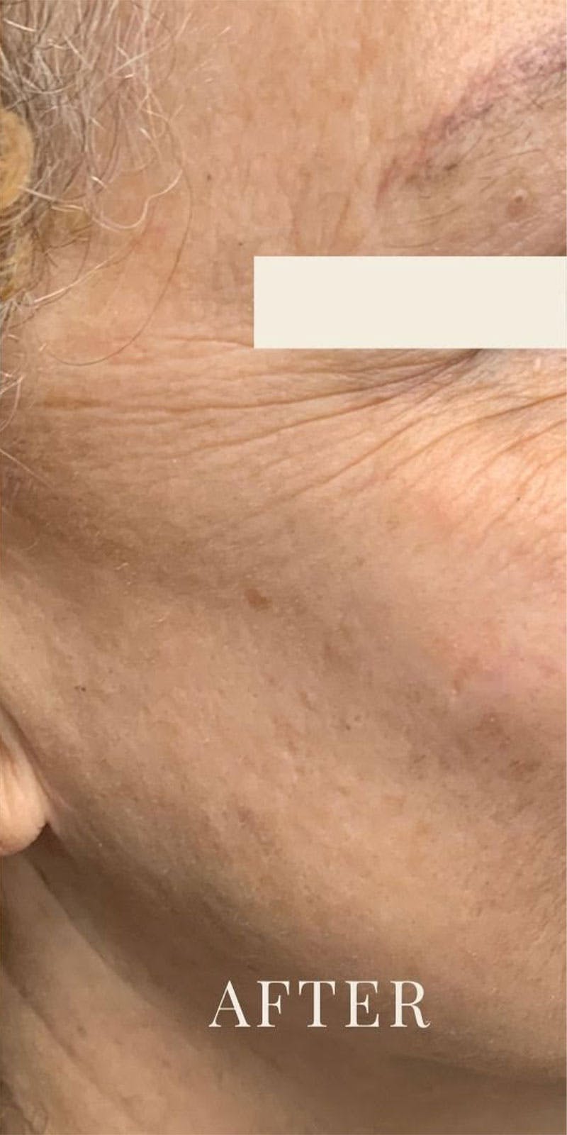 IPL Before & After Gallery - Patient 112346 - Image 2