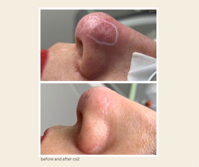 UltraPulse Laser Before & After Gallery - Patient 222584 - Image 1