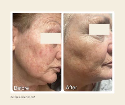 UltraPulse Laser Before & After Gallery - Patient 156706 - Image 1