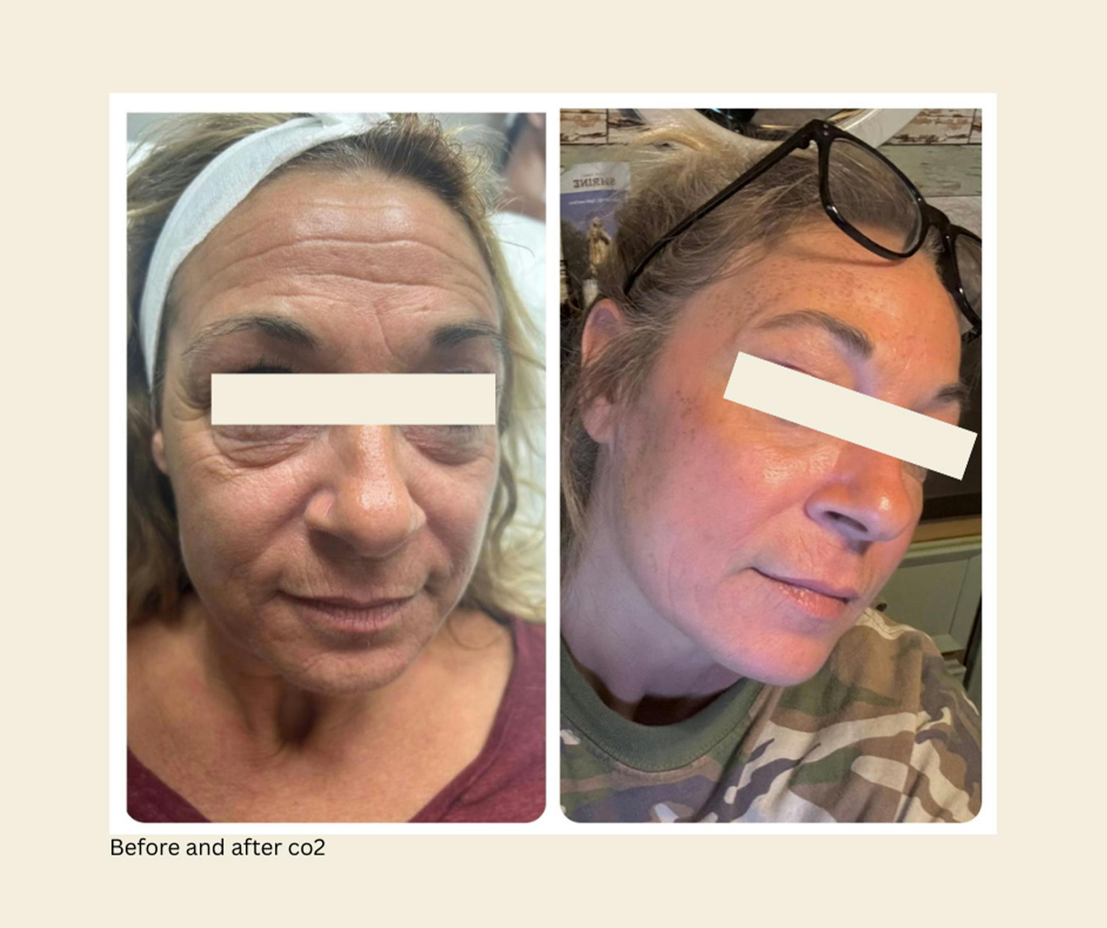 UltraPulse Laser Before & After Gallery - Patient 187374 - Image 1