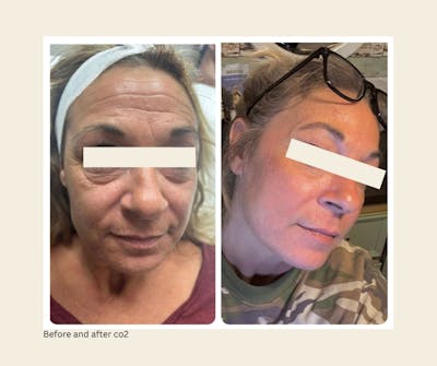 UltraPulse Laser Before & After Gallery - Patient 187374 - Image 1