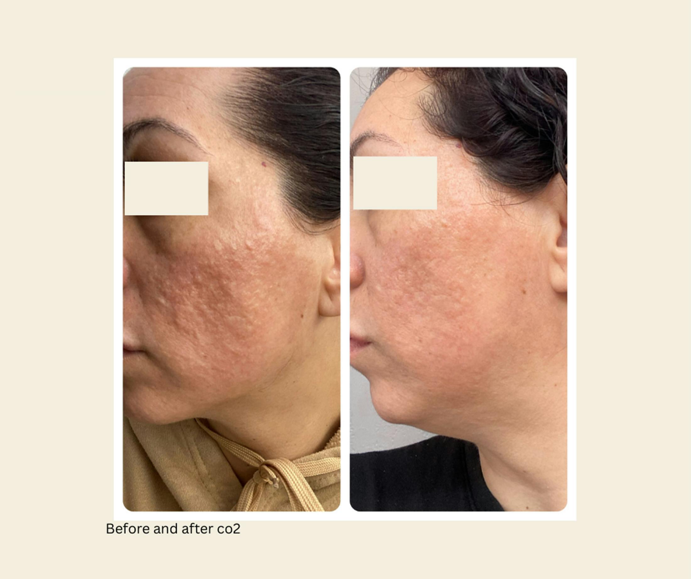 UltraPulse Laser Before & After Gallery - Patient 752574 - Image 1