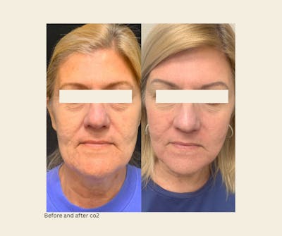 UltraPulse Laser Before & After Gallery - Patient 428544 - Image 1