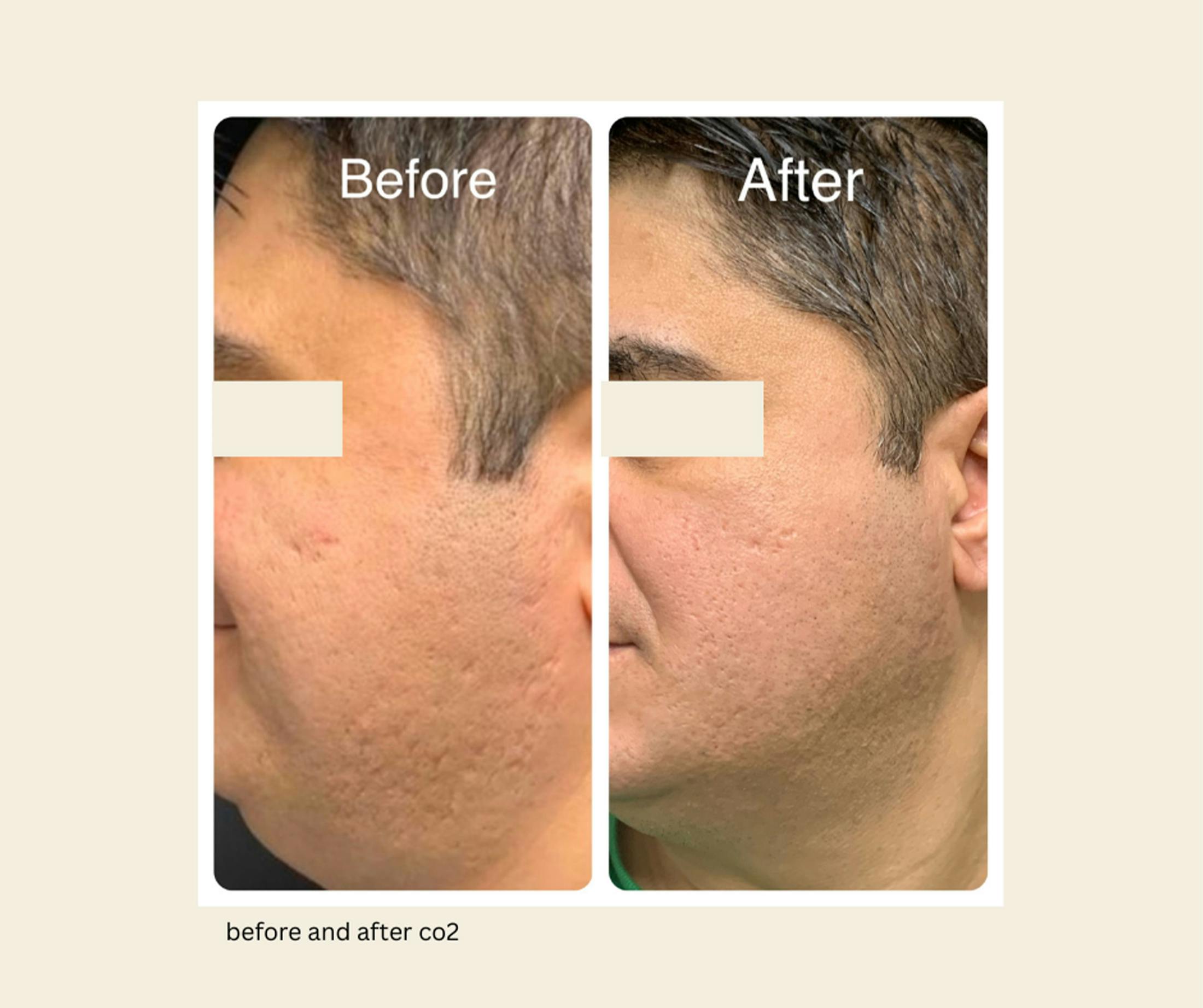 UltraPulse Laser Before & After Gallery - Patient 309088 - Image 1