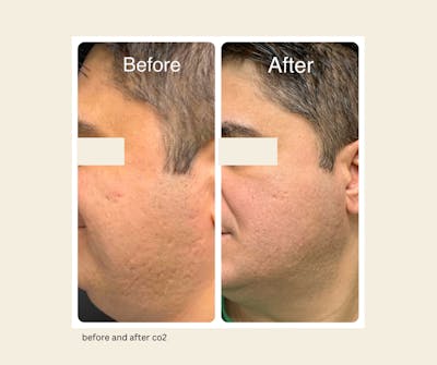 UltraPulse Laser Before & After Gallery - Patient 309088 - Image 1