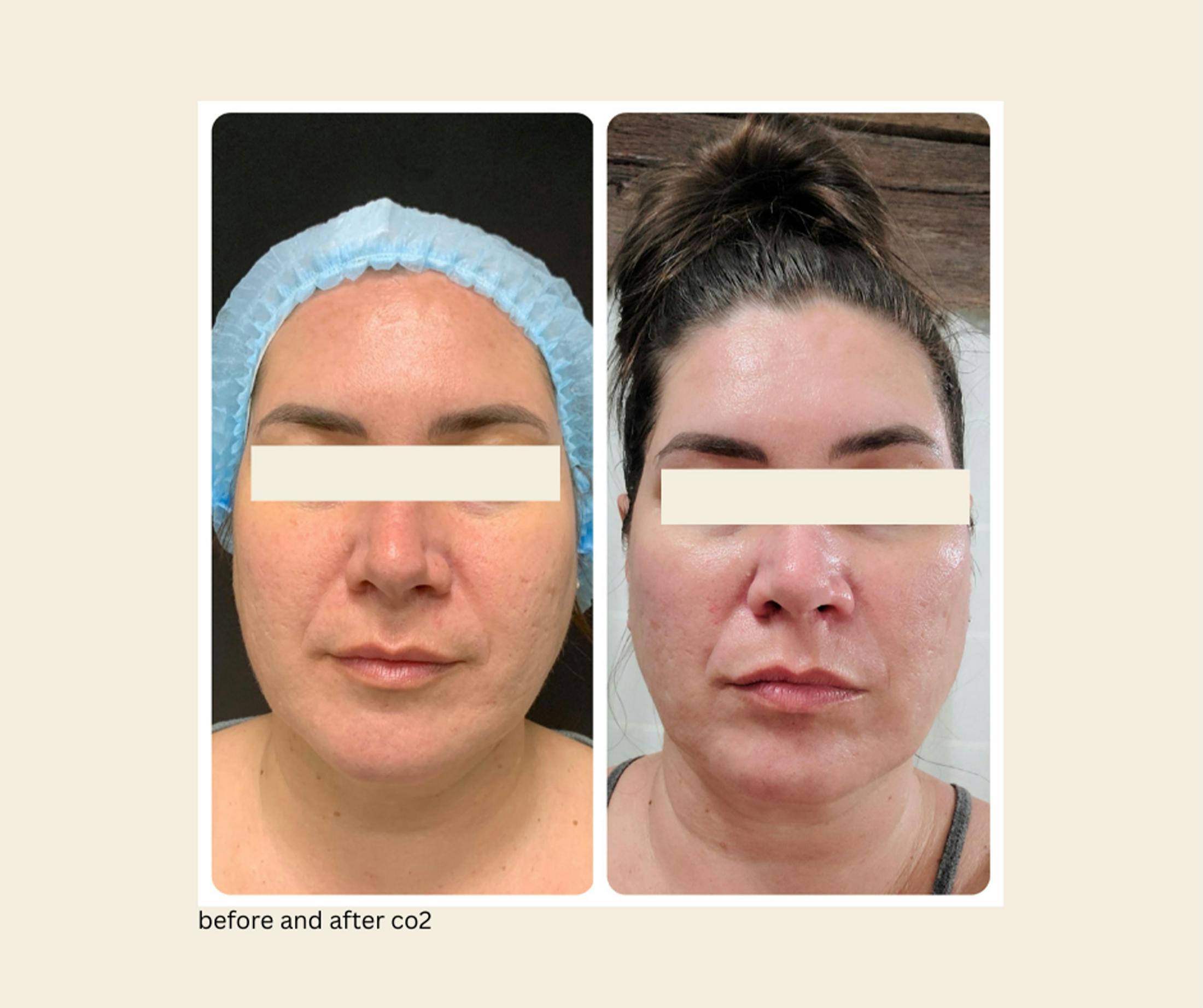 UltraPulse Laser Before & After Gallery - Patient 139135 - Image 1