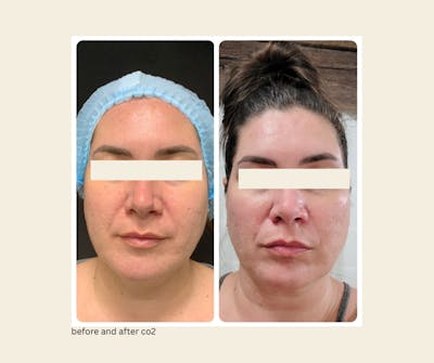 UltraPulse Laser Before & After Gallery - Patient 139135 - Image 1