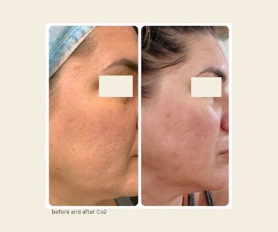 UltraPulse Laser Before & After Gallery - Patient 174608 - Image 1