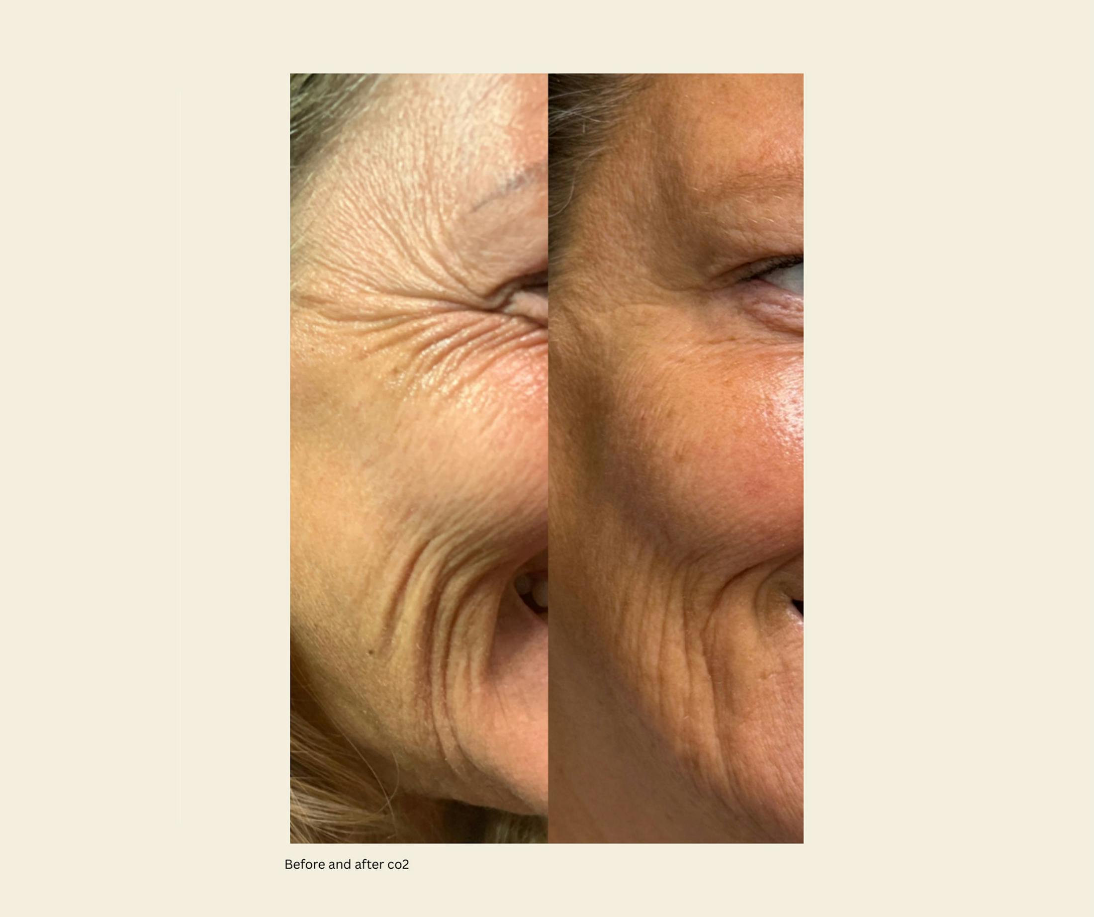 UltraPulse Laser Before & After Gallery - Patient 884256 - Image 1