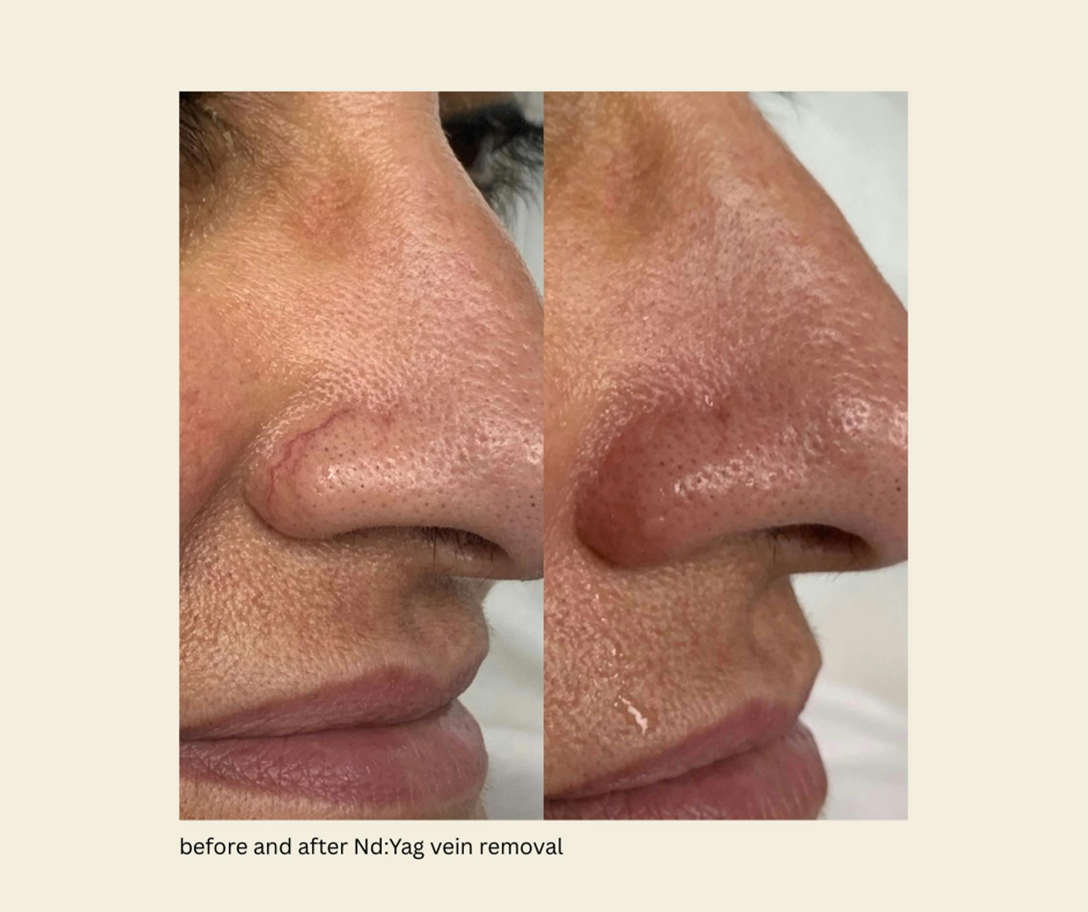 YAG Laser Before & After Gallery - Patient 260015 - Image 1