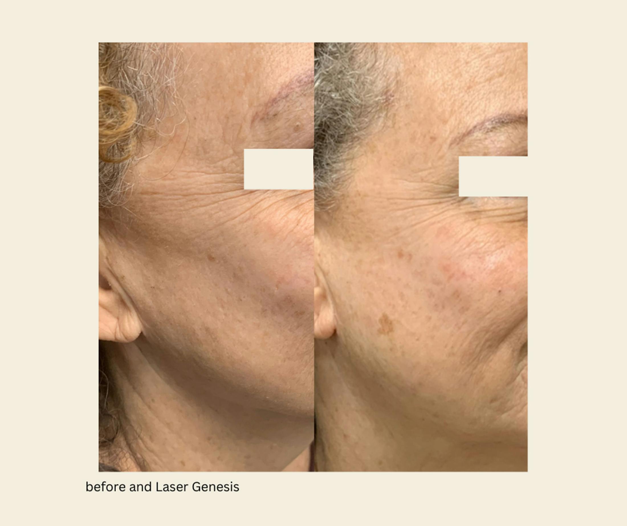 Laser Genesis Before & After Gallery - Patient 162704 - Image 1
