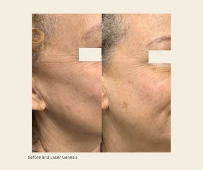 Laser Genesis Before & After Gallery - Patient 162704 - Image 1