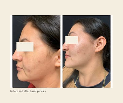 Laser Genesis Before & After Gallery - Patient 152744 - Image 1