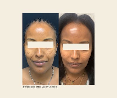 Laser Genesis Before & After Gallery - Patient 549614 - Image 1