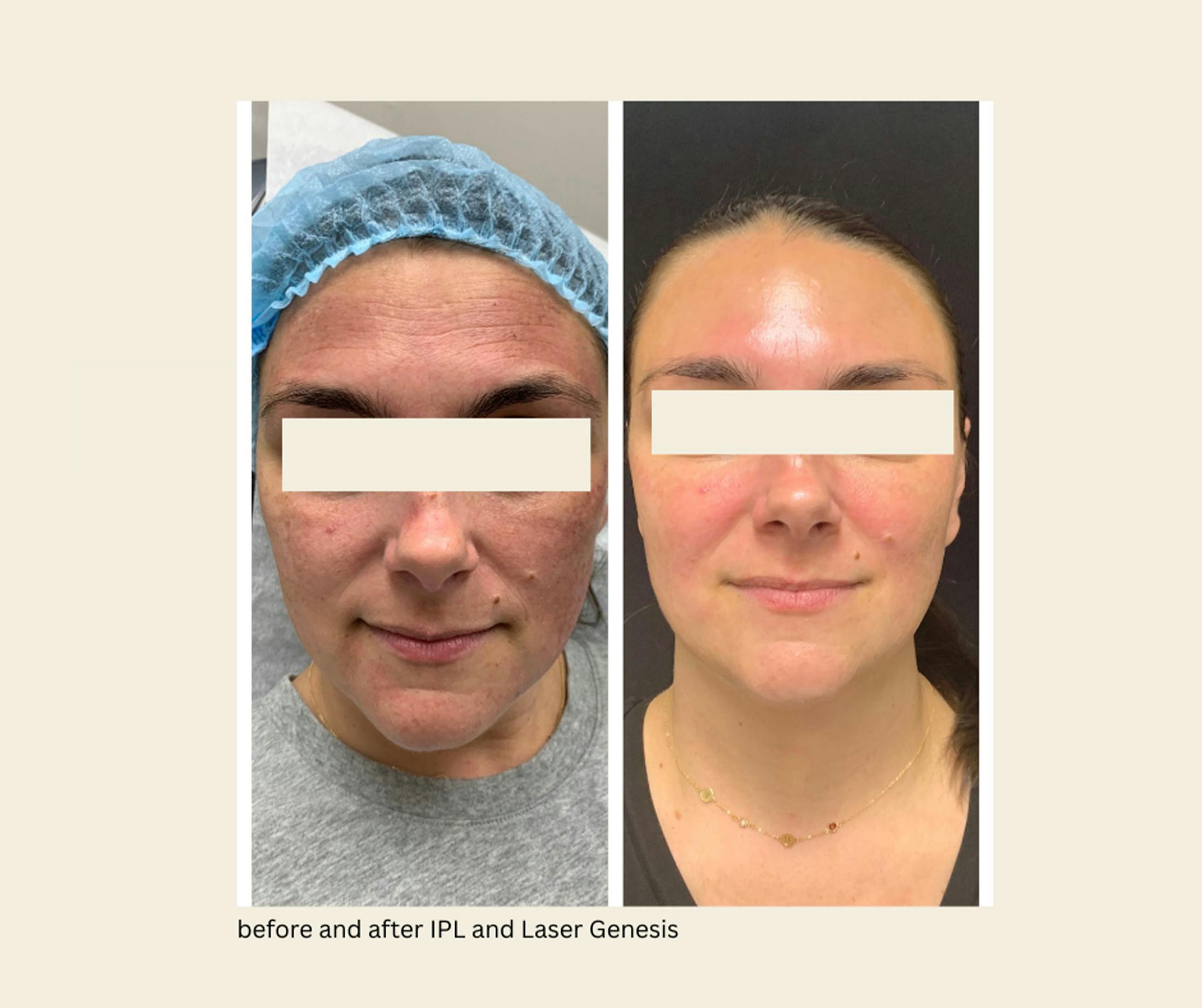 IPL Before & After Gallery - Patient 264265 - Image 1