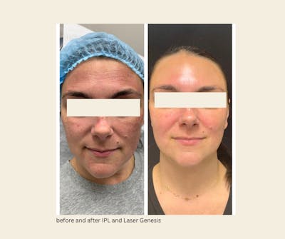 IPL Before & After Gallery - Patient 264265 - Image 1