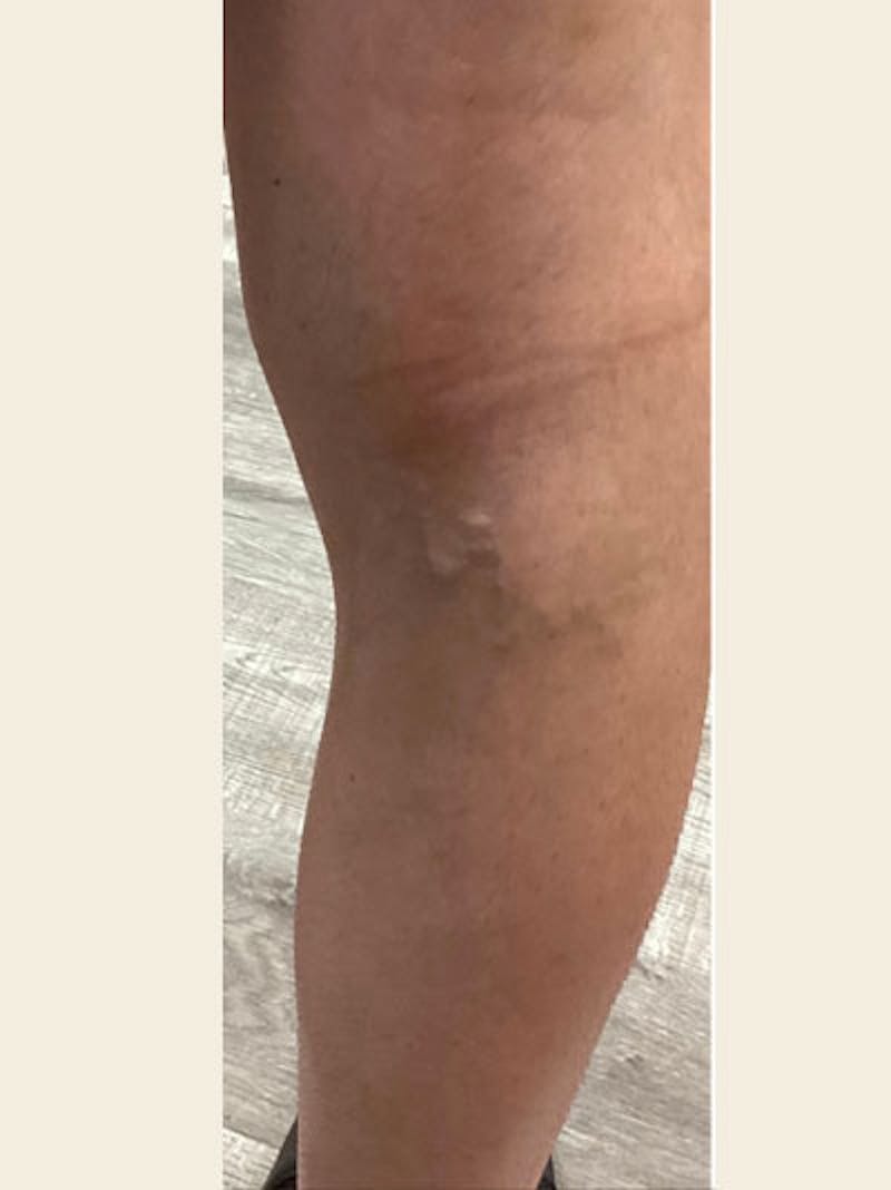 Vein Ablation Before & After Gallery - Patient 251148 - Image 2