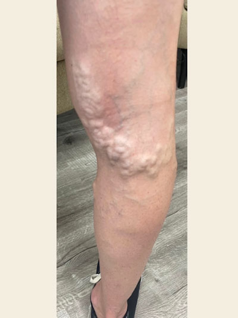 Vein Ablation Before & After Gallery - Patient 251148 - Image 1