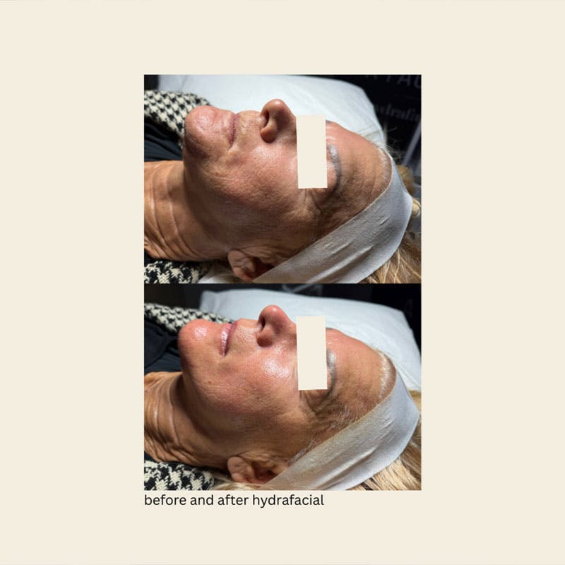 Hydrafacial Syndeo Before & After Gallery - Patient 859163 - Image 1