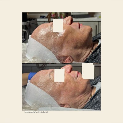 Hydrafacial Syndeo Before & After Gallery - Patient 328429 - Image 1