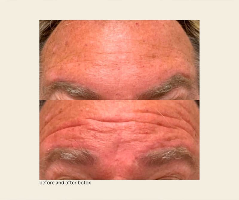 BOTOX Before & After Gallery - Patient 220535 - Image 1