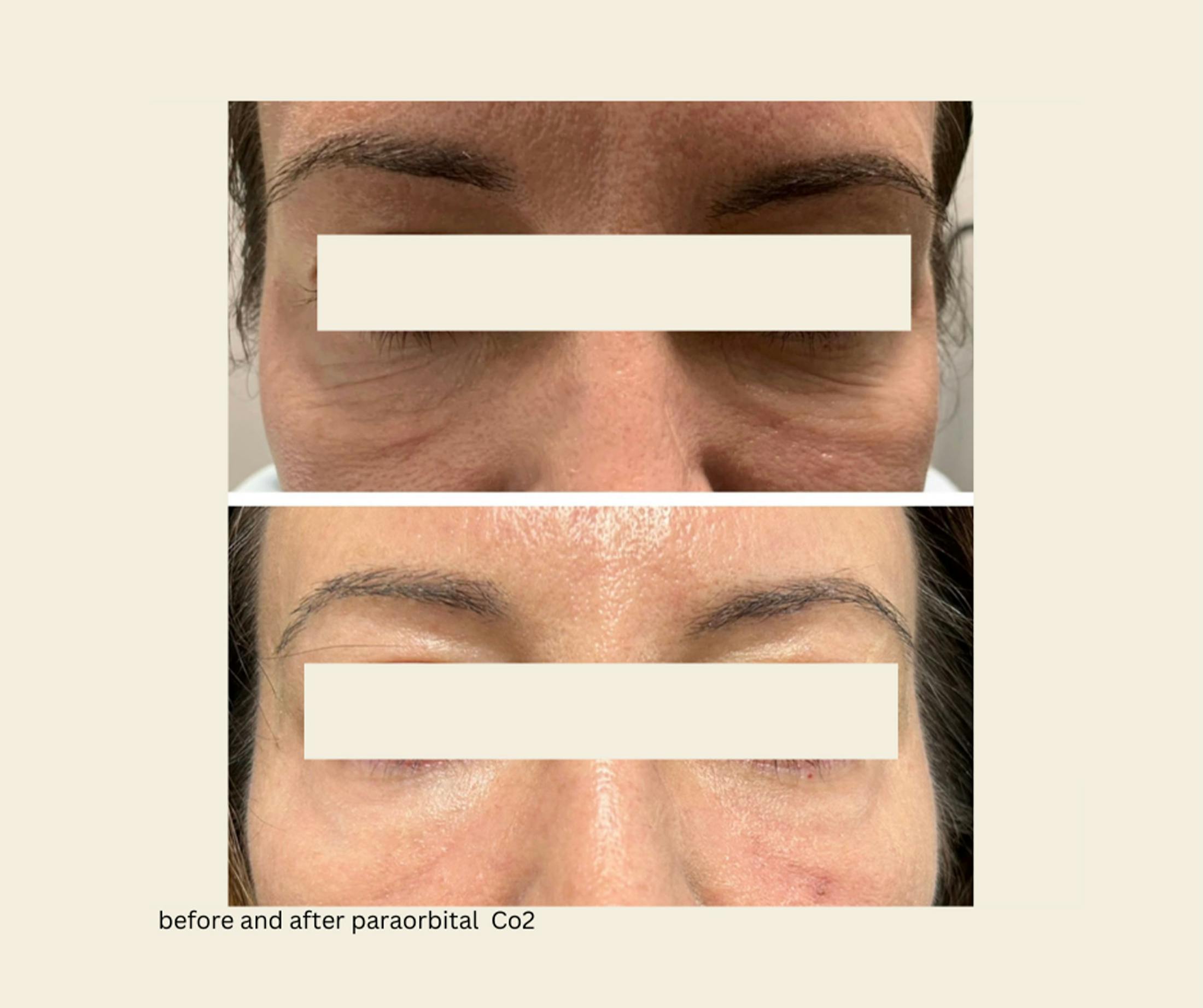 UltraPulse Laser Before & After Gallery - Patient 238876 - Image 1
