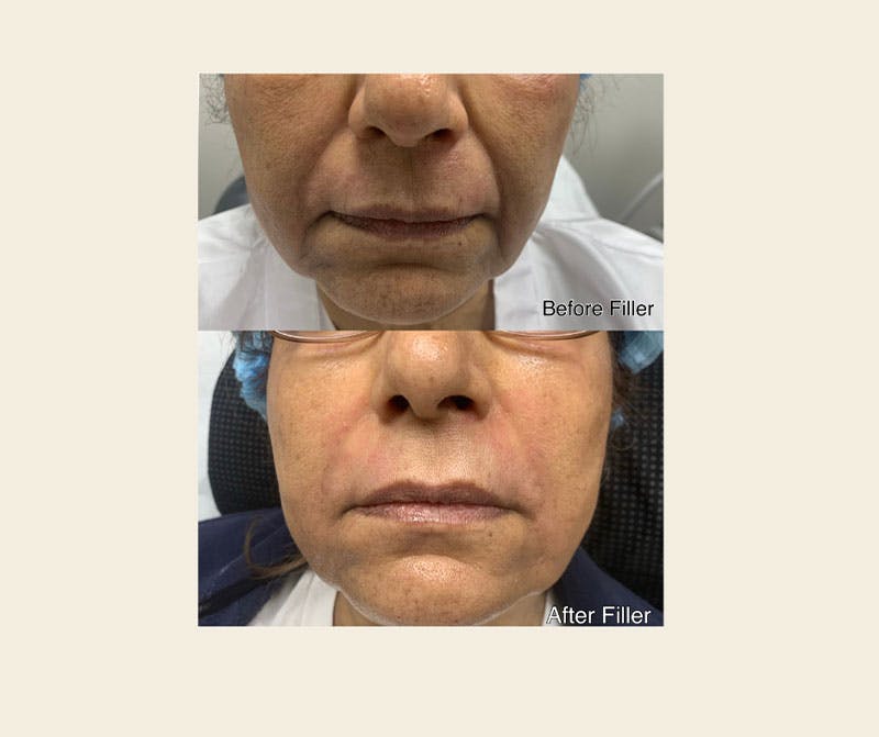 Dermal Fillers Before & After Gallery - Patient 223395 - Image 1