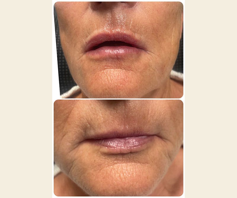 Dermal Fillers Before & After Gallery - Patient 226190 - Image 1