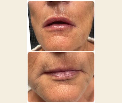 Dermal Fillers Before & After Gallery - Patient 226190 - Image 1