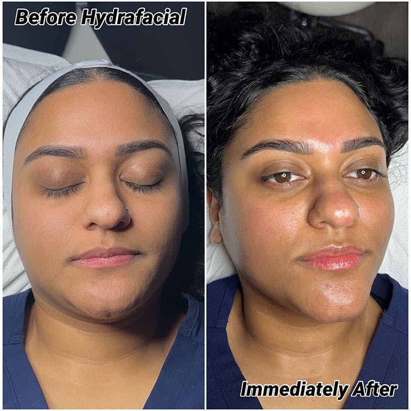 Hydrafacial Syndeo Before & After Gallery - Patient 318301 - Image 1