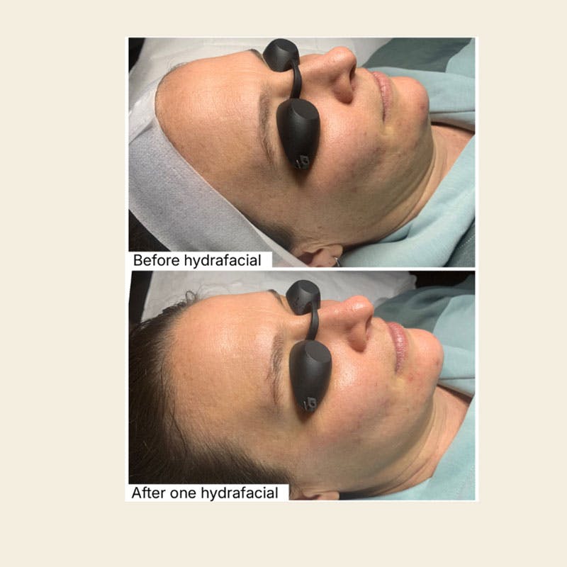 Hydrafacial Syndeo Before & After Gallery - Patient 174392 - Image 1