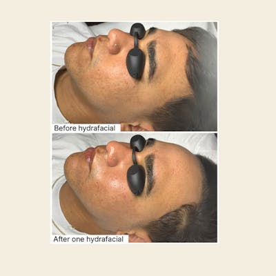 Hydrafacial Syndeo Before & After Gallery - Patient 365293 - Image 1