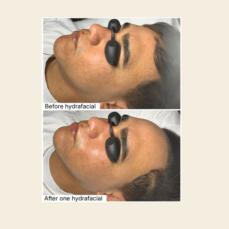 Hydrafacial Syndeo Before & After Gallery - Patient 365293 - Image 1