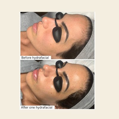 Hydrafacial Syndeo Before & After Gallery - Patient 443166 - Image 1