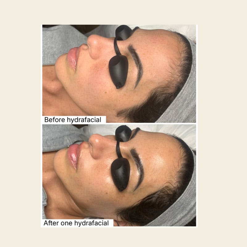 Hydrafacial Syndeo Before & After Gallery - Patient 443166 - Image 1