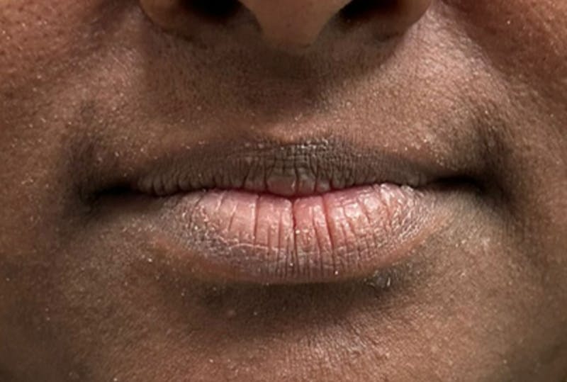 Lip Fillers Before & After Gallery - Patient 229407 - Image 1