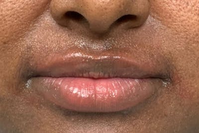 Lip Fillers Before & After Gallery - Patient 229407 - Image 2