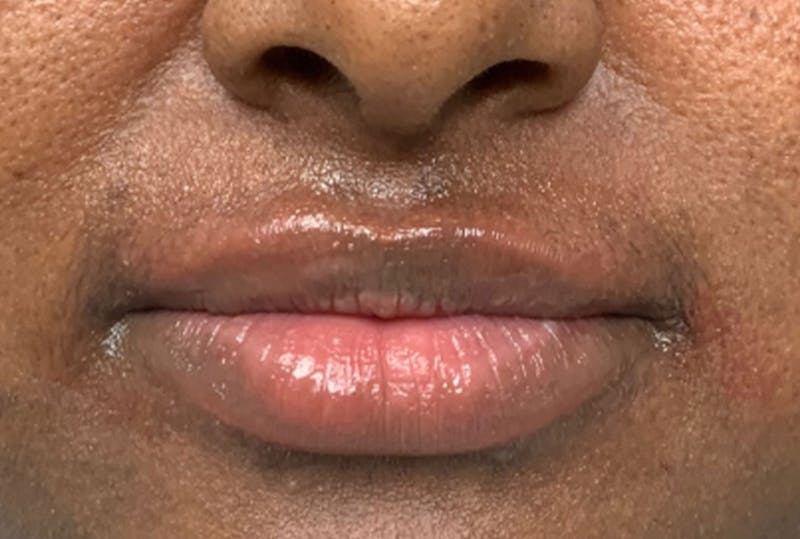 Lip Fillers Before & After Gallery - Patient 229407 - Image 2