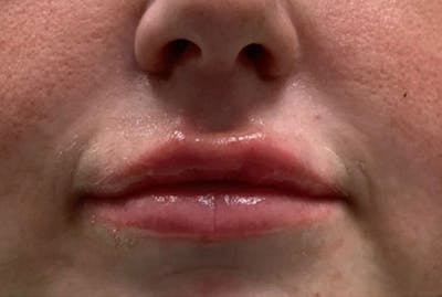 Lip Fillers Before & After Gallery - Patient 194367 - Image 2
