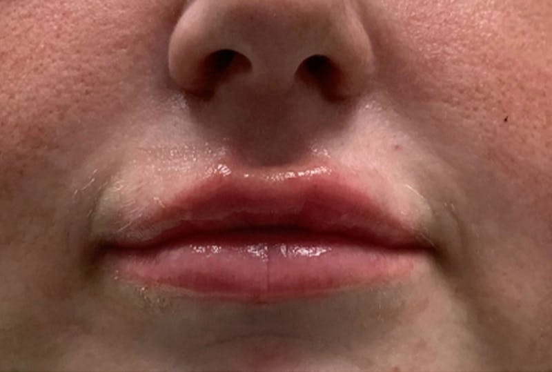 Lip Fillers Before & After Gallery - Patient 194367 - Image 2