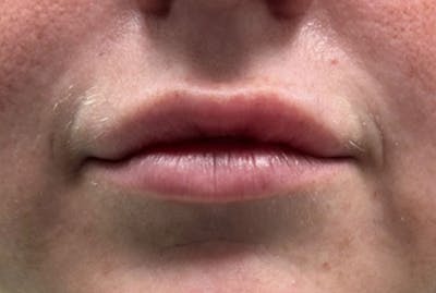 Lip Fillers Before & After Gallery - Patient 194367 - Image 1