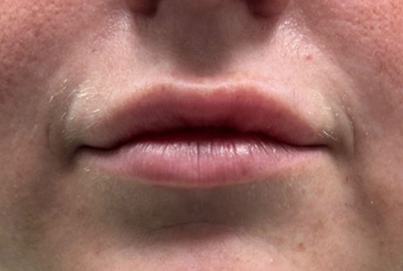 Lip Fillers Before & After Gallery - Patient 194367 - Image 1