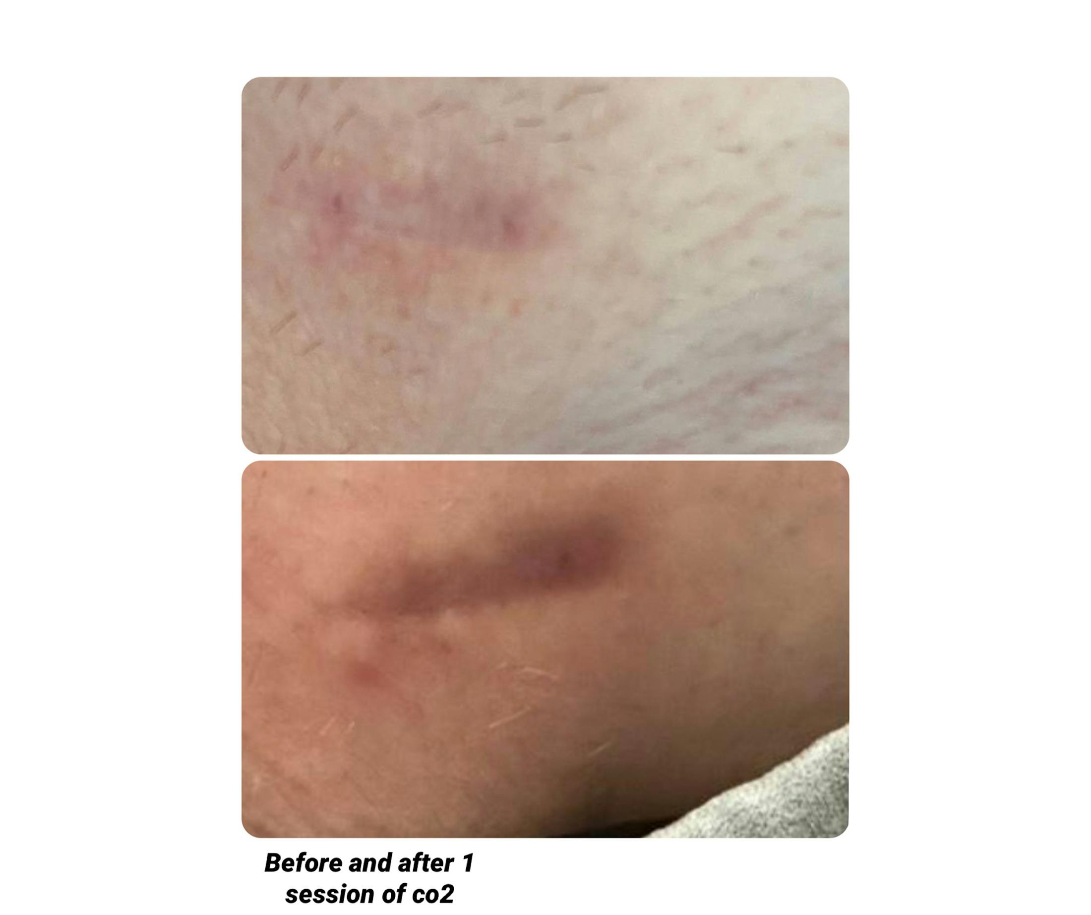 UltraPulse Laser Before & After Gallery - Patient 812275 - Image 1