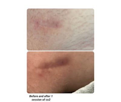 UltraPulse Laser Before & After Gallery - Patient 812275 - Image 1