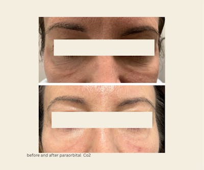 UltraPulse Laser Before & After Gallery - Patient 176035 - Image 1