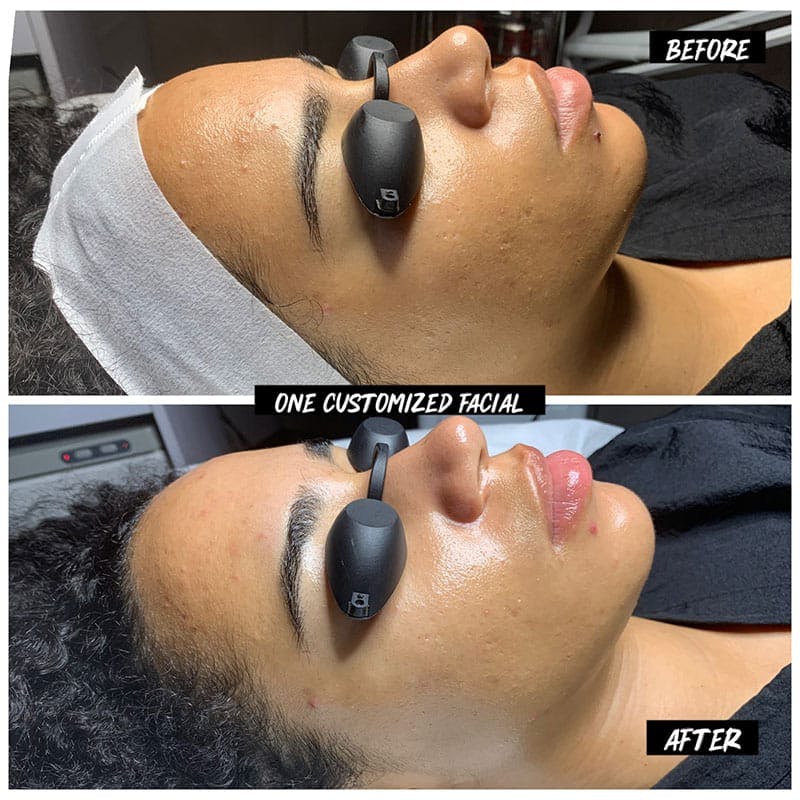 Hydrafacial Syndeo Before & After Gallery - Patient 212586 - Image 1