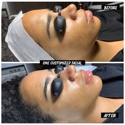 Hydrafacial Syndeo Before & After Gallery - Patient 212586 - Image 1