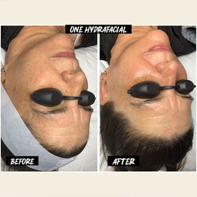 Hydrafacial Syndeo Before & After Gallery - Patient 366867 - Image 1