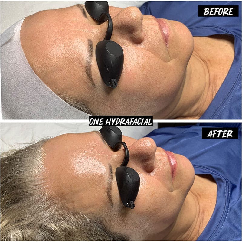 Hydrafacial Syndeo Before & After Gallery - Patient 875414 - Image 1